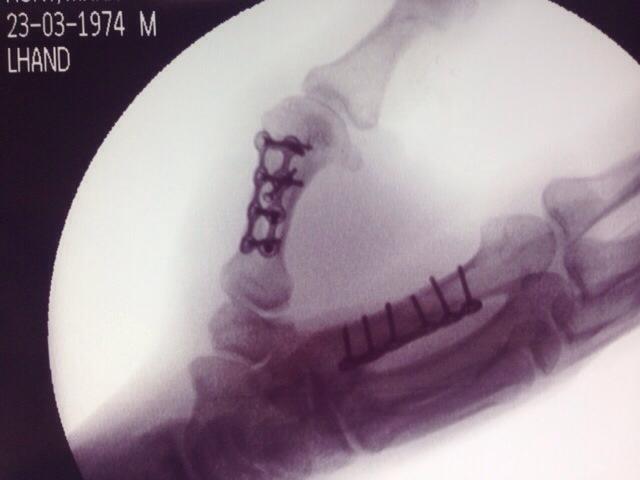 an X-ray of a damaged hand showing wiring and bolts in two of the fingers